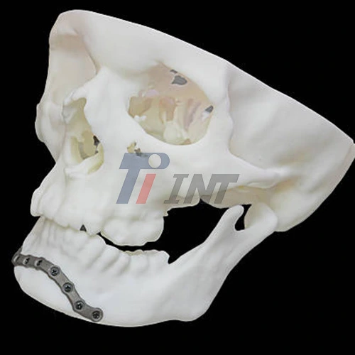 titanium plate for mandibular fracture titanium plate for mandibular fracture