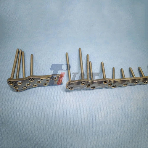 titanium plate in chest titanium plate in chest