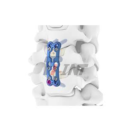 neck surgery with titanium plate neck surgery with titanium plate