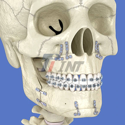 titanium plate for mandibular fracture titanium plate for mandibular fracture