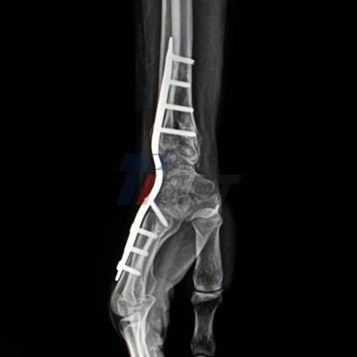 titanium plate for wrist fracture