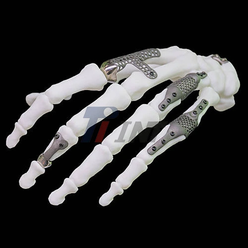 titanium plate hand surgery