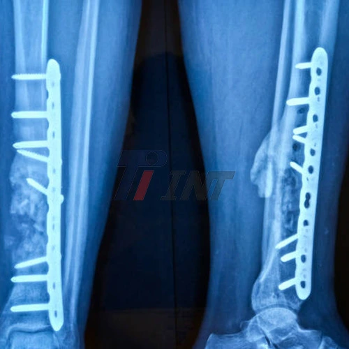 titanium plate in leg titanium plate in leg