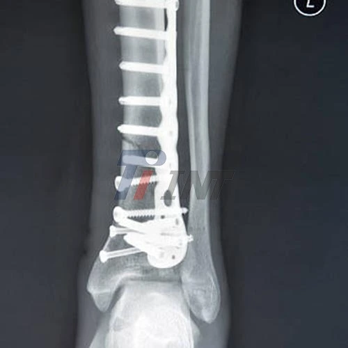titanium plate in leg titanium plate in leg
