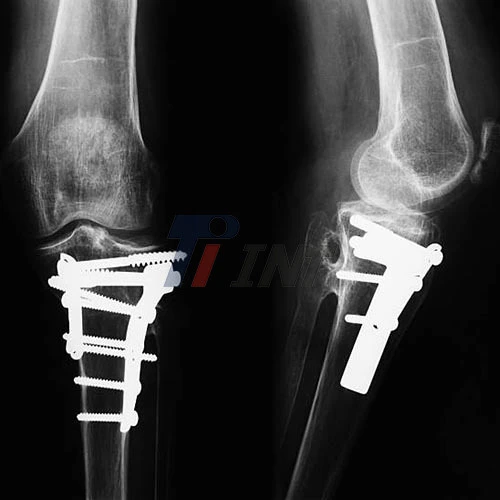 titanium plate in leg