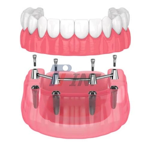 milled titanium bar dental