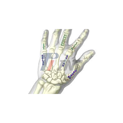 titanium plate for broken wrist