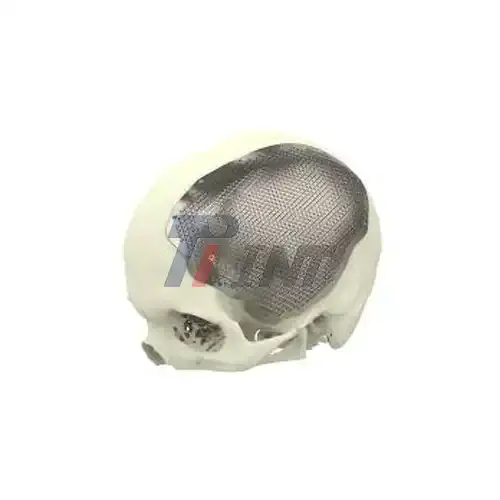 titanium plate brain surgery