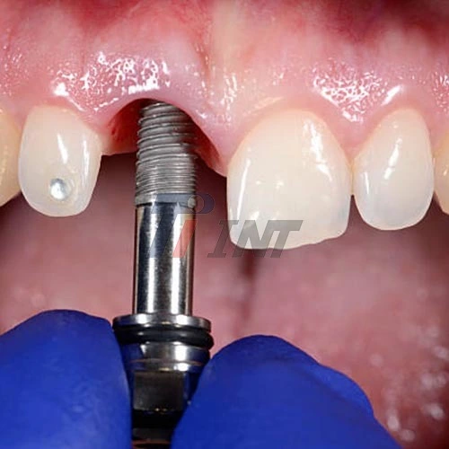 titanium bar dental implants
