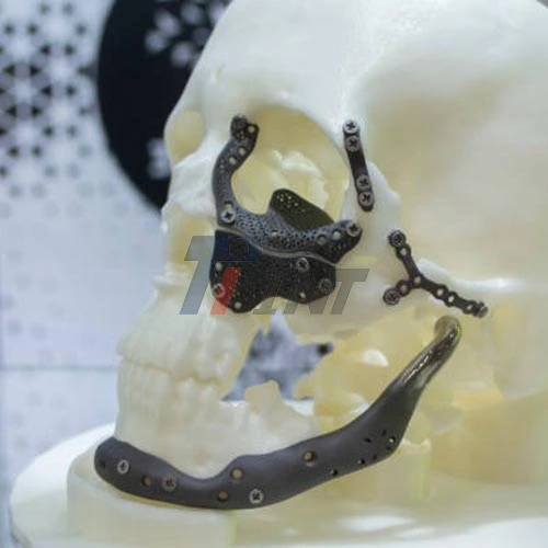 maxillofacial surgery titanium plates