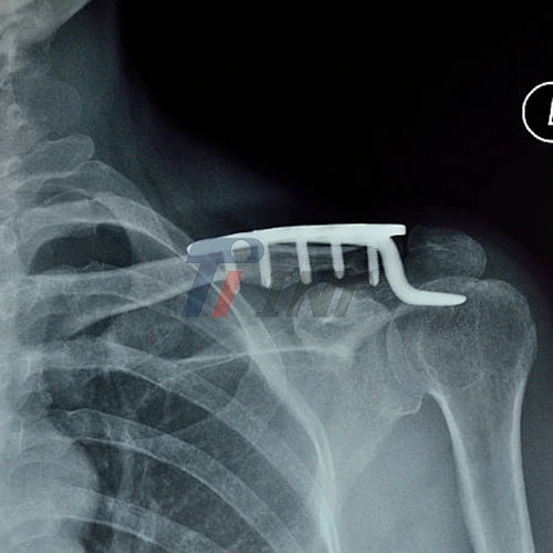 titanium plate for collar bone