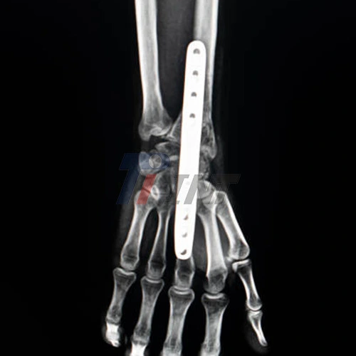 titanium plate for broken wrist
