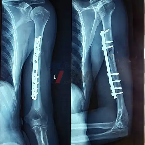 titanium plate for bone fracture