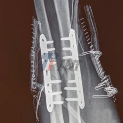 titanium plate for bone fracture
