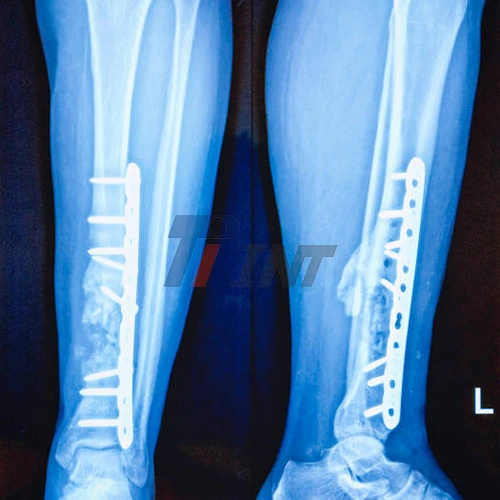 titanium plate for bone