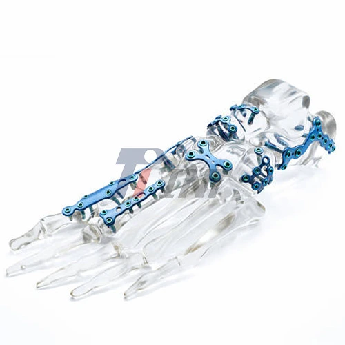 titanium plate hand surgery