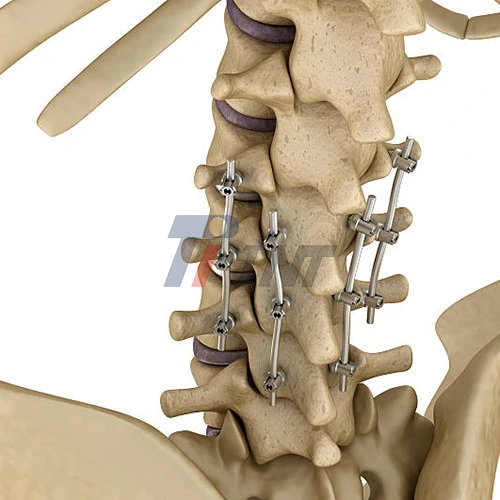 titanium rod medical
