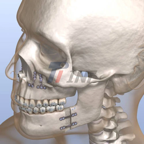 maxillofacial surgery titanium plates
