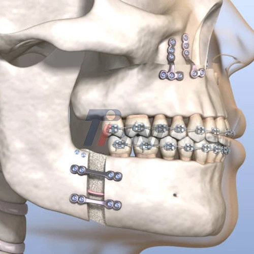 titanium plate for mandibular fracture