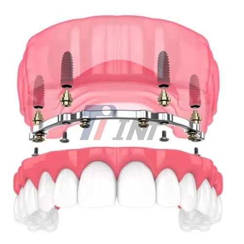 milled titanium bar dental